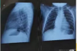 脊柱侧弯“长短腿”？中医正骨免手术！