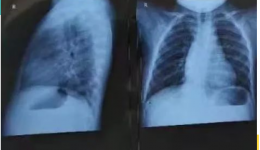 脊柱侧弯“长短腿”？中医正骨免手术！