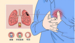 【骨折患者必读】深静脉血栓防治攻略