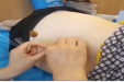 什么是普通针刺？