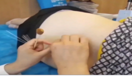 什么是普通针刺？